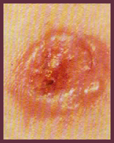 Basal Cell Carcinoma