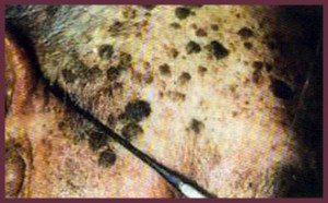 seborrheic keratosis