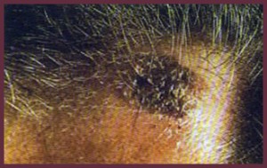 seborrheic keratosis