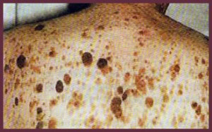 seborrheic keratosis