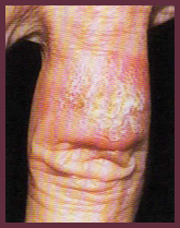 Squamous Cell Carcinoma